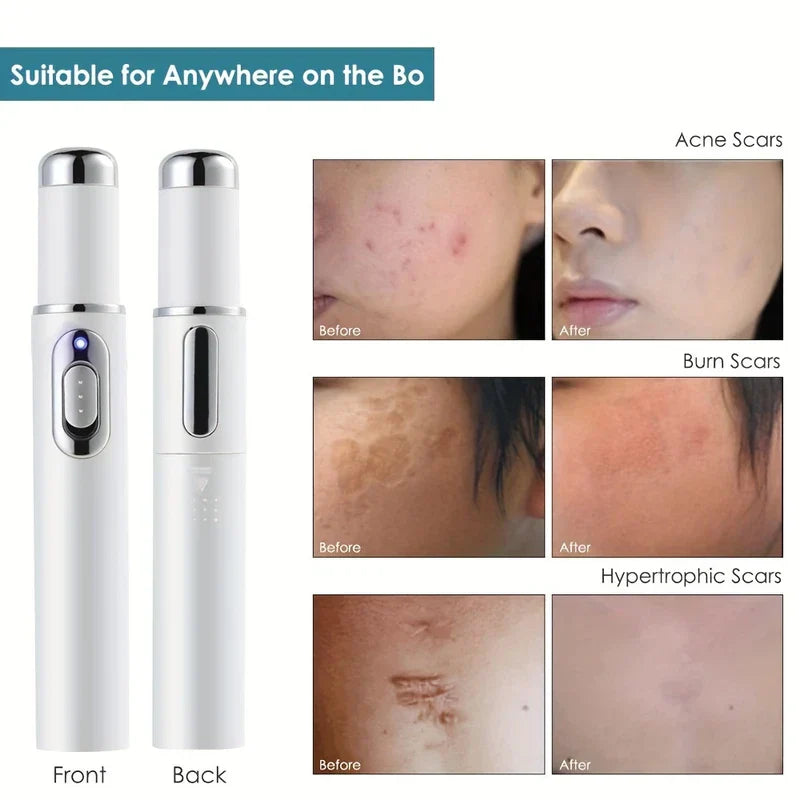 Blue Light Therapy Acne Treatment Pen