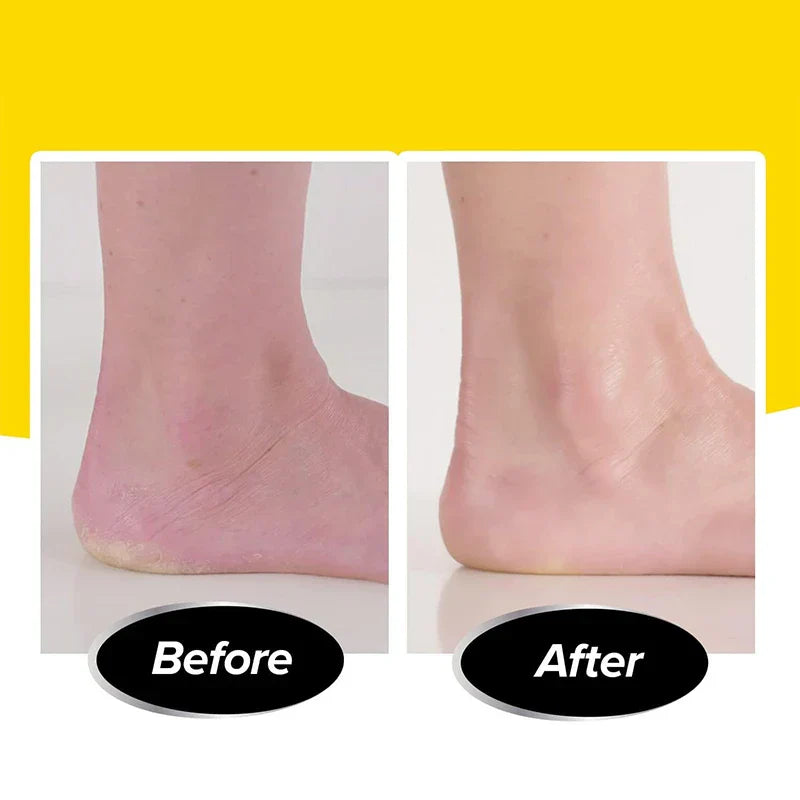 Electric Callus Remover with Built-in Vacuum