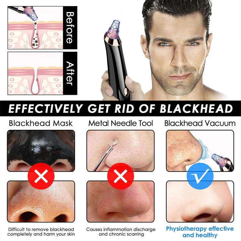 Facial Comedone Extractor Vacuum Device