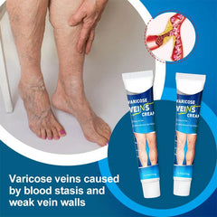 Varicose Vein Treatment Relief Cream