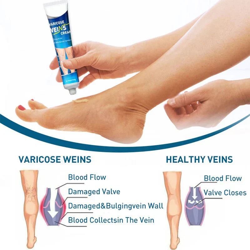 Varicose Vein Treatment Relief Cream